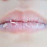 Bibirmu Sering Pecah-pecah? Coba Atasi dengan Cara Ini 8